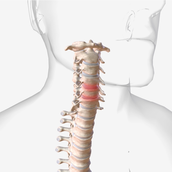 Cervical spine injury illustration