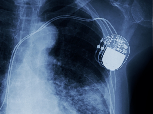 X-ray image of permanent pacemaker implant in chest body