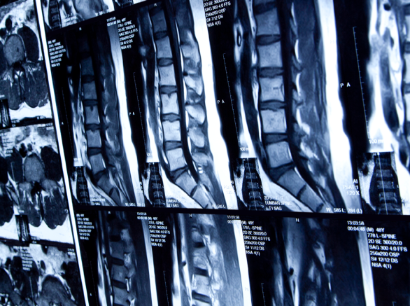 MRI scan of human lumbar spine