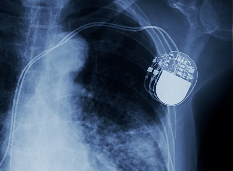X-ray reveals a medical device such as a pacemaker. Exponent performs critical analysis to determine the safety of new technologies.