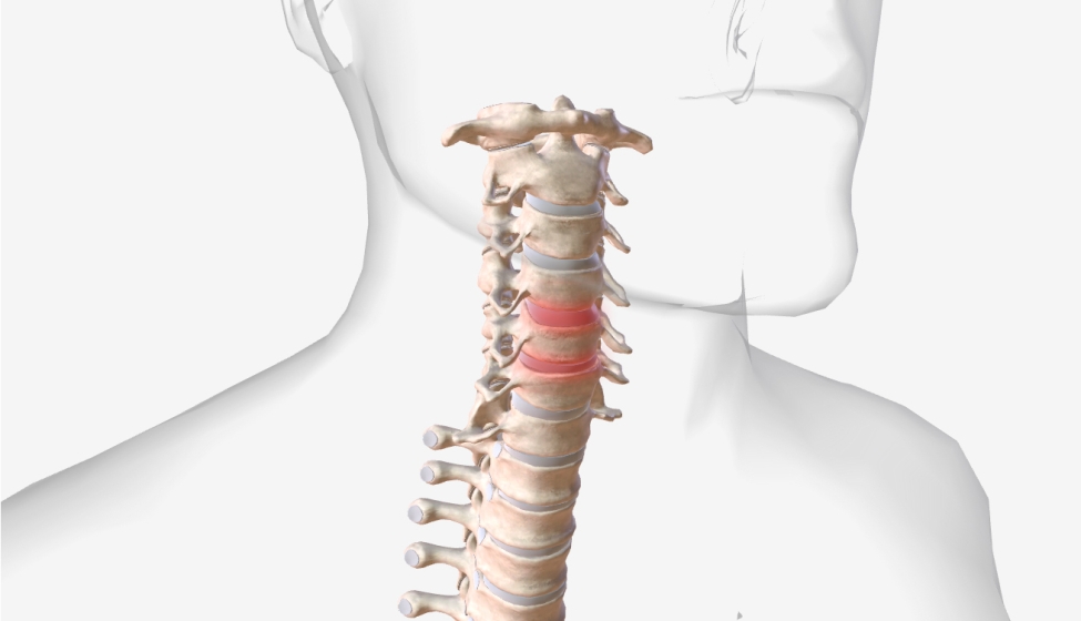Cervical spine injury illustration