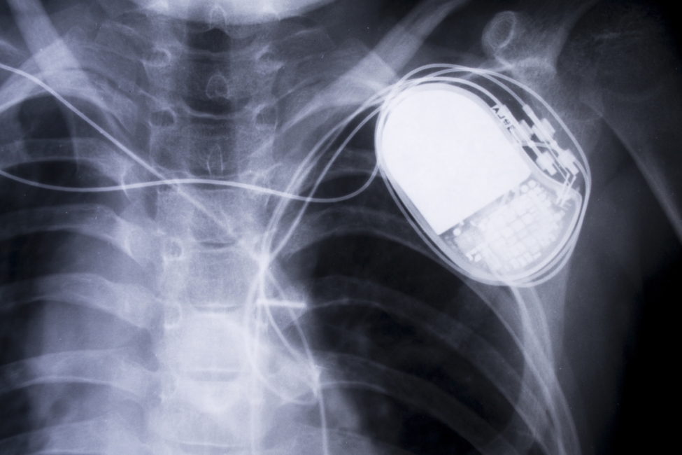 X-ray scan of a person's chest with a pacemaker