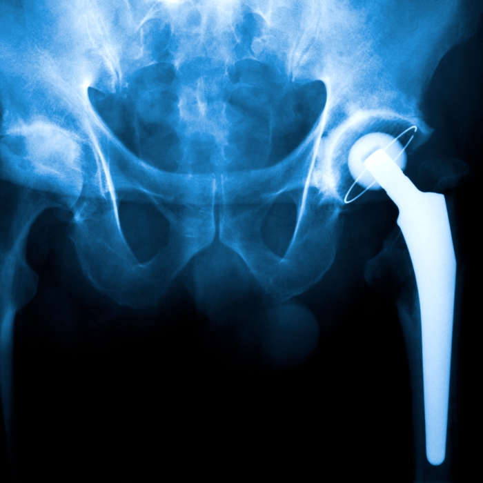 X Ray of a hip joint problem