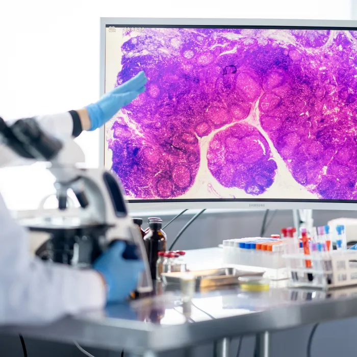 A small team of medical laboratory technicians gather around a monitor as they take a closer look together at cells under a microscope. They are each wearing lab coats, protective eyewear and gloves as they diligently work.
