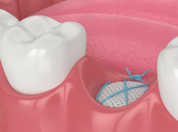 Dental bone grafting