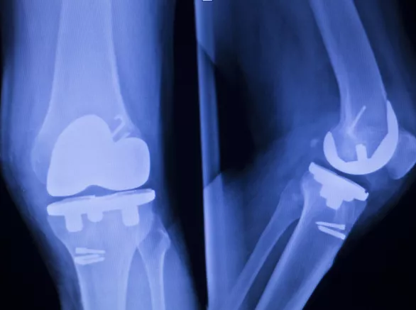 X-ray showing bones
