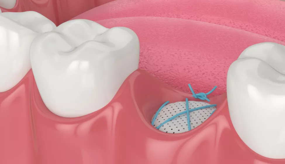 Dental bone grafting