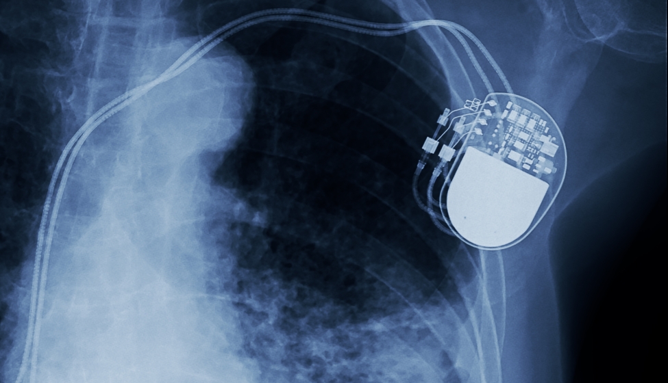 X-ray image of permanent pacemaker implant in chest body