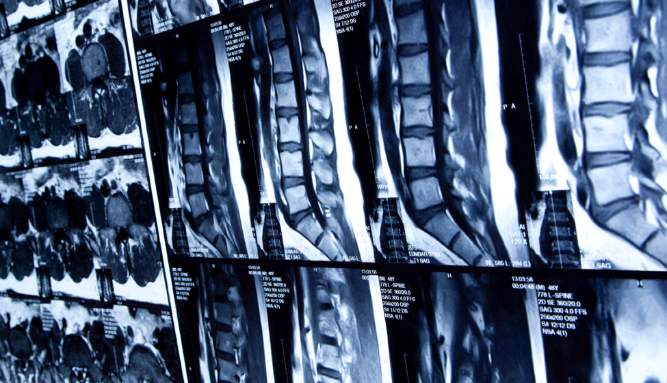 MRI scan of human lumbar spine